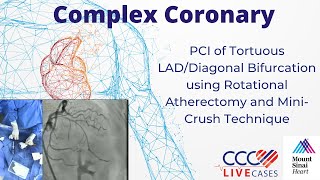 PCI of Tortuous LADDiagonal Bifurcation using Rotational Atherectomy amp MiniCrush Technique Nov 2023 [upl. by Rramo151]