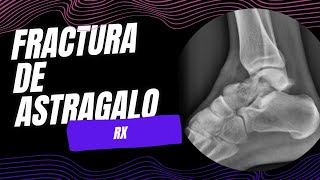 Fractura de astrágalo [upl. by Oinotnanauj]