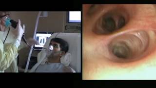 Bronchoscopy with BAL [upl. by Lennie3]