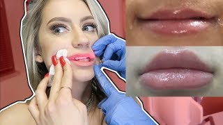 ALL ABOUT MY BOTCHED LIP INJECTIONS [upl. by Alahs]