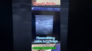 Plazmolifting muolajasi bo’g’imlarga super davo revmatolog doctor medical osteoartritis [upl. by Fredek814]