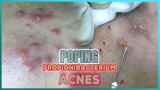 Big Cystic Acne Blackheads Extraction Blackheads amp Milia Whiteheads Removal Pimple Popping [upl. by Consalve]