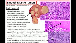 Mesenchymal Tumors of the Uterus Kurts Notes [upl. by Graham970]