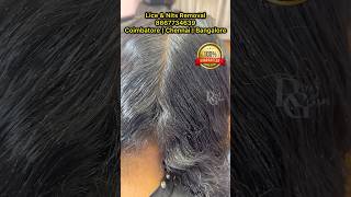 Lice removallicelice treatment in parlourhow to treat lice in hairhow to prevent from licenits [upl. by Sianna234]