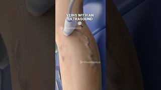 Super glue for your veins 3D Animation [upl. by Eugenides]