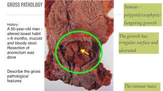 Pathology of Colorectal Cancer Adenocarcinoma [upl. by Onaimad688]