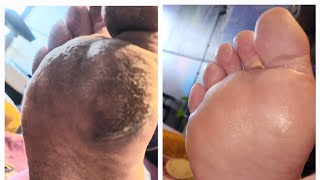 Amazing Callous Treatment for soft feet [upl. by Eeldarb]