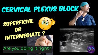 SUPERFICIAL CERVICAL PLEXUS BLOCK 🔴🔴 ULTRASOUNDGUIDED 🔴🔴 LANDMARK amp LOR 🔴🔴 TIPS amp TRICKS [upl. by Aseen]