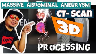 How to do 3D processing using Canon Genesis CT Scan work station [upl. by Alael361]