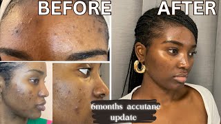 GETTING RID OF ACNE amp HYPERPIGMENTATION  6 MONTHS ACCUTANE UPDATE  ACCUTANE JOURNEY [upl. by Ylrebnik]