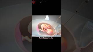 What is an amniocentesis  Amniotic fluid check up [upl. by Yaras]