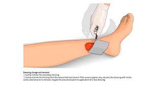 How to use the Silvercel NonAdherent Hydro Alginate Antimicrobial Dressing [upl. by Ecertal]