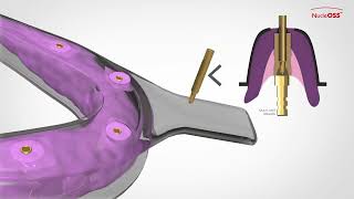 NucleOSS T6 Implant  Vidalı Çözümler  Açık Kaşık Ölçü Parçaları  Kullanım TR [upl. by Nroht]