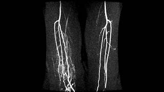 Time Resolved Magnetic Resonance Angiography of the legs [upl. by Sylas789]