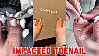 Satisfying Ingrown Toenail Removal Compilation 1 [upl. by Posehn596]