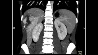 Abdomen Liver Cavernous Hemangioma of the Liver8 of 9 [upl. by Oicor]