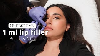 I GOT LIP FILLERS FOR THE FIRST TIME  1ML [upl. by Etat560]