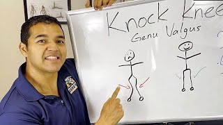 Knock knee problem solution with EXERCISES in 7 days [upl. by Ynhoj]