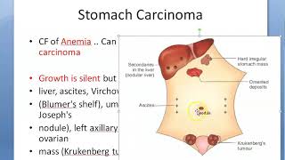 Surgery Stomach Carcinoma spread silent cancer Blumer shelf Sister mary joseph nodule Irish [upl. by Brew960]