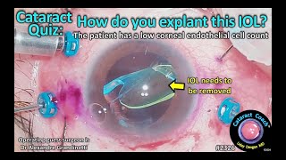 CataractCoach™ 2326 Cataract Quiz™ How do you explant this IOL [upl. by Mert]