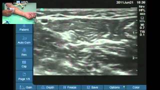 Ultrasound variation in anatomy of ulnar nerve left side [upl. by Amerak542]