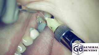 Infiltration anesthesia for extraction 26 tooth and implantation area 2526 [upl. by Hgalehs]