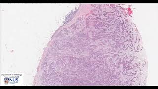 Pleura Mesothelioma epithelioid Microscopy  Talking slide [upl. by Mcnalley615]