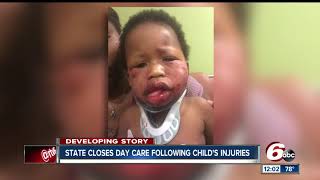 State closes Indianapolis day care after 1yearold seriously hurt [upl. by Helsie]