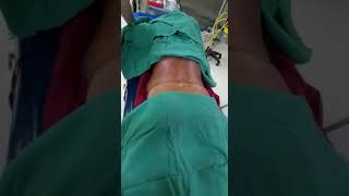 Vertebroplasty procedure  drNoman [upl. by Allianora506]