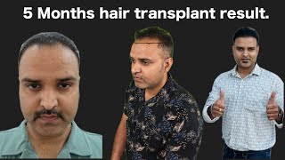 My hair transplant result after 5 months Timelapse [upl. by Arretak182]