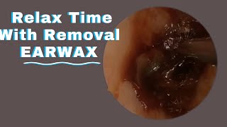 P15Safe Methods for Ear Wax RemovalHELLO HEALTH asmr [upl. by Laira]