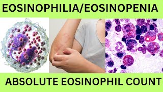 EOSINOPHILIAEOSINOPENIAABSOLUTE EOSINOPHIL COUNTAECHYPEREOSINOPHILIC SYNDROMEEOSINOPHILLEUKEMIA [upl. by Minsk136]