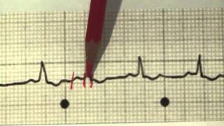 EKG für Pflege Teil 14  tachykarde Sinusarrhythmie interpretieren [upl. by Serg358]