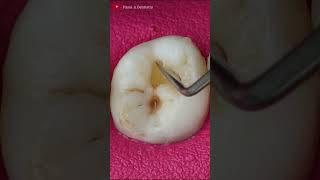 Small Teeth Cavities toothrestoration satisfying [upl. by Stanfill6]