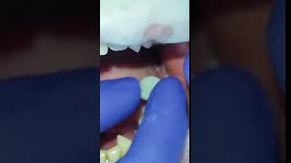 Fixing 2nd molar crown for 2 implants in lower jaw  milled pmma and single piece implantsshorts [upl. by Haidabez]