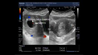 A Pregnancy of 7 weeks Ultrasound Findings [upl. by Peggir]