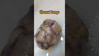 Breast lump excision biopsy for histopathology😨 breastcancer breastdisease breastfeeding lump [upl. by Yekcin777]