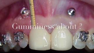 Correcting gummy smile with TADs [upl. by Tager]