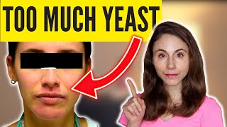 6 SIGNS OF TOO MUCH YEAST SKIN DrDrayzday [upl. by Leaj774]