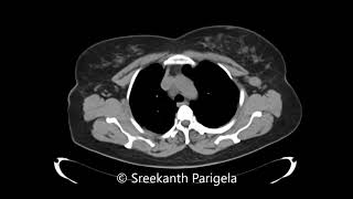 Breast cancer  CT Chest [upl. by Anattar328]