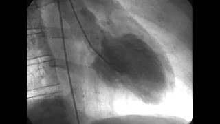 Procedural Coronary Angiography of Coronary Artery Thrombus Aspiration Followed by Bolus Intracorona [upl. by Mariquilla]