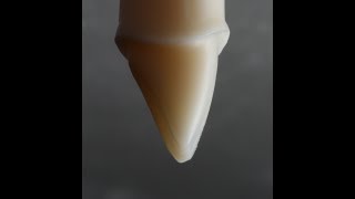 All Ceramic Crown Preparation for Emax and Zirconia [upl. by Fontes684]