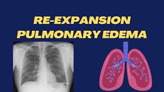 ReExpansion Pulmonary Edema  Simple Explanation  High Yield Points  Respiratory Lecture10 [upl. by Abehsile]