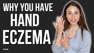 THIS IS WHY YOU HAVE HAND ECZEMA 🖐 DERMATOLOGIST DrDrayzday [upl. by Amora]