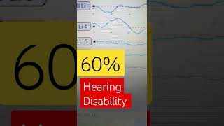 bera test for hearing disabledviraltradingberahearingaidspeechbera [upl. by Edva595]