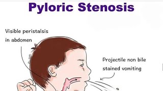 Pyloric Stenosis [upl. by Torre]