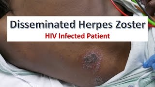 Disseminated Herpes Zoster Infection in an HIV Patient [upl. by Morell]