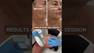 HIFU The NonSurgical Facelift Solution in Dubai  Vilafortuny [upl. by Nillek]