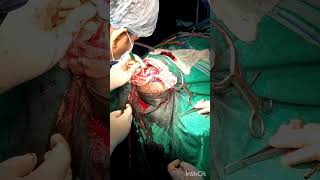 Craniotomy Procedure mbbsdairies mbbs aiimsdelhi biharmedicalcollege medico doctor [upl. by Lebyram]