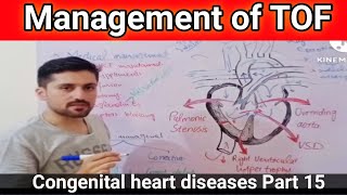 tetralogy of fallot management  blalock taussig shunt  waterston shunt procedure  tof heart [upl. by Sset]